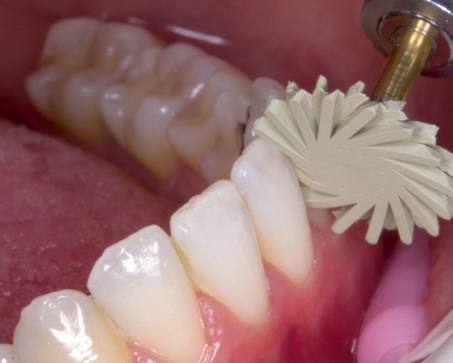  Kit EVE Diacomp twist - Basic CA