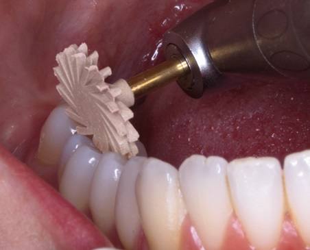  Kit EVE Diacomp twist - Basic CA